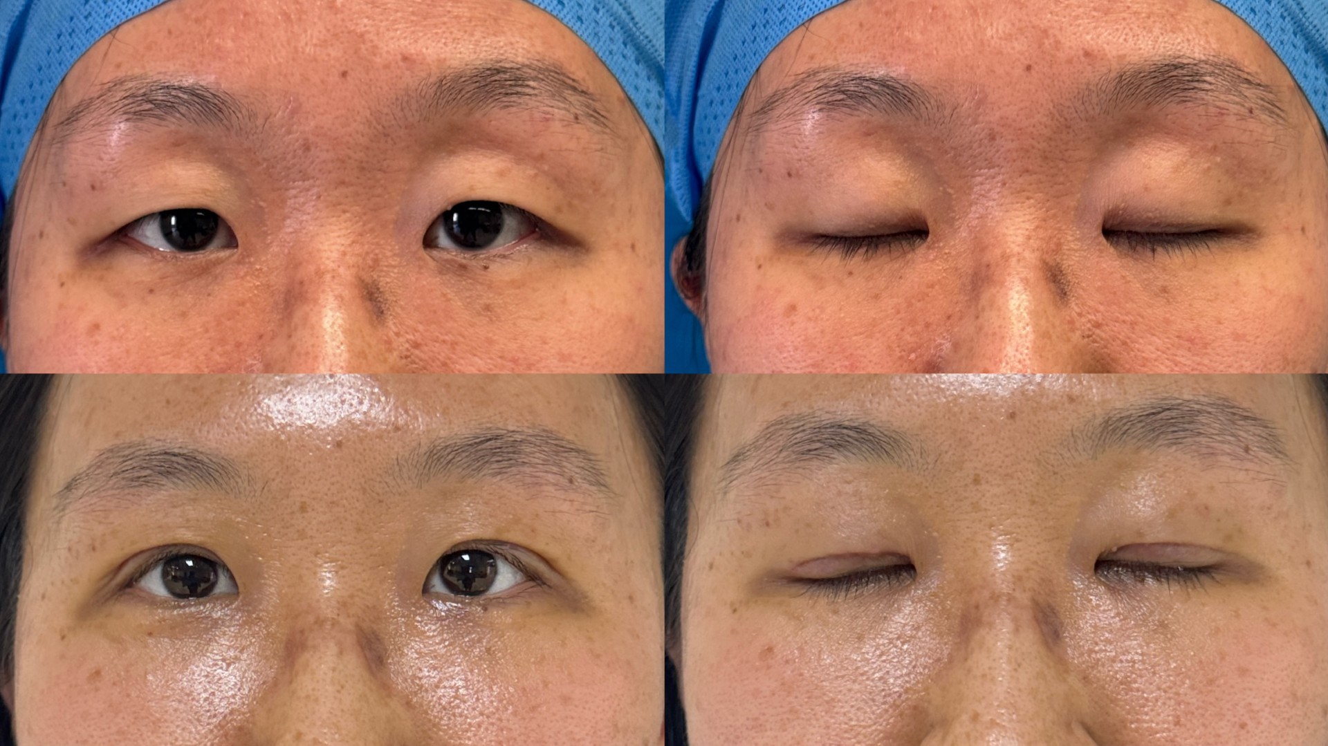 Patient Before & After — Ptosis Correction & Upper Blepharoplasty