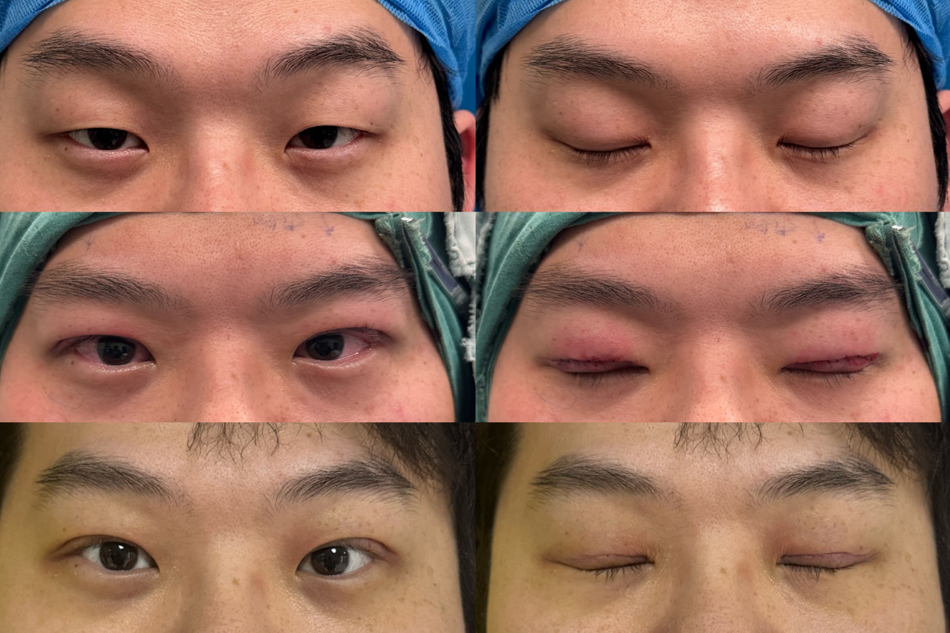 Patient Before & After — Ptosis Correction & Upper Blepharoplasty